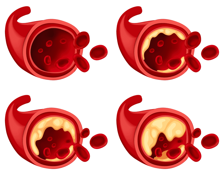 Diretriz de dislipidemia da AACE: recomendações para tratar hipercolesterolemia
