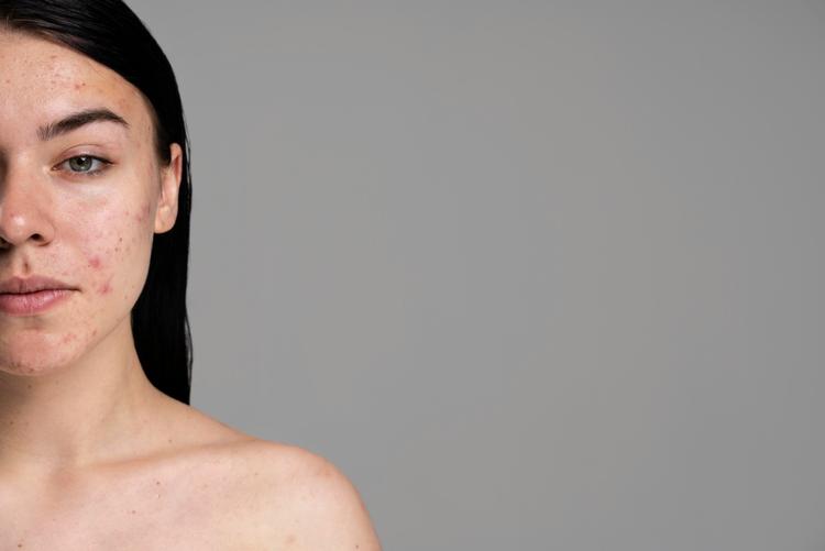 O Peróxido de Benzoíla usado no tratamento de acne causa câncer?