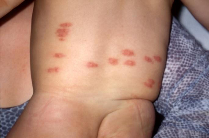 Prurigo estrófulo: como conduzir?