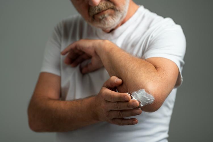 Spevigo (Espesolimabe): Uma nova medicação no tratamento da psoríase pustulosa generalizada (PPG)