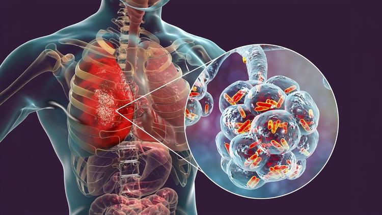 Tratamento de Pneumonia