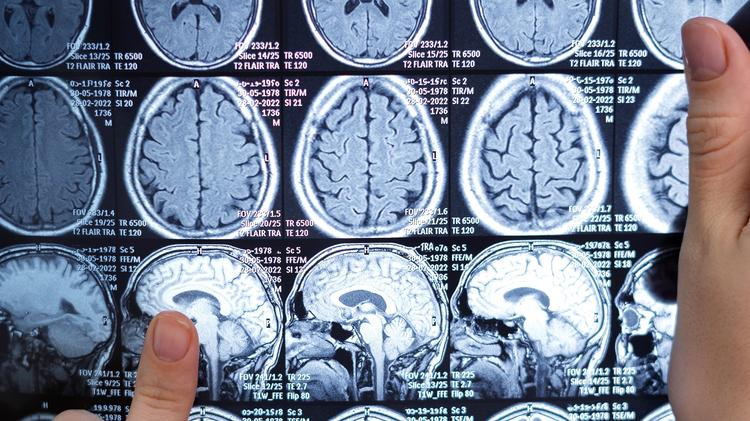 Doença de pequenos vasos cerebrais: Qual o papel das células do sistema imune?