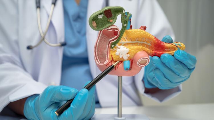 câncer de pâncreas