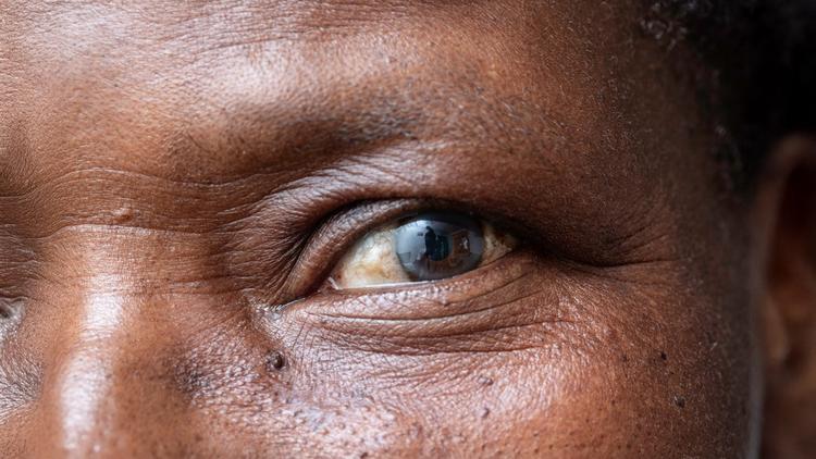 degeneração macular