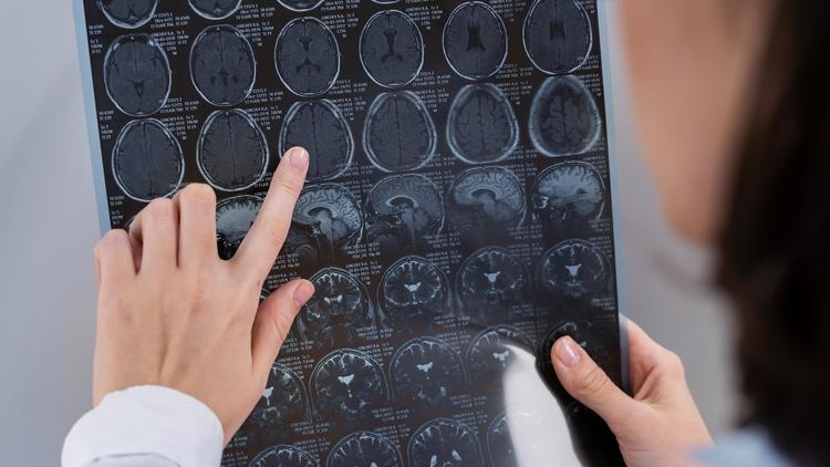 Tirofiban no AVC agudo: revisão sistemática avalia as atuais evidências