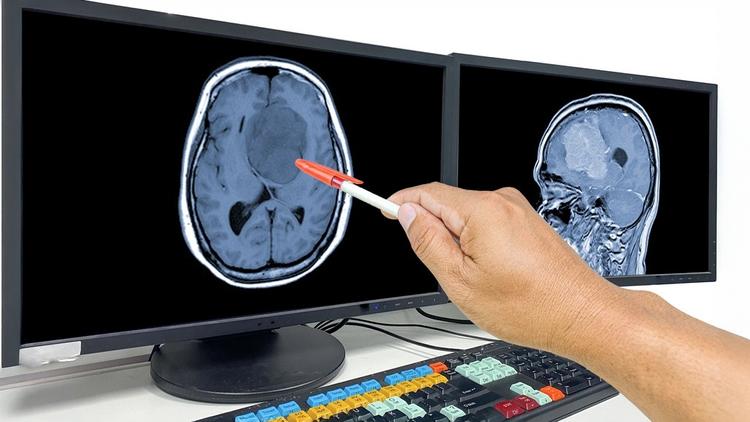 diretriz europeia tumores hipofisários 2025