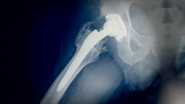 artroplastia quadril