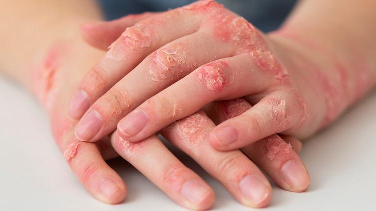 Psoríase: riscos de mortalidade associados à doença