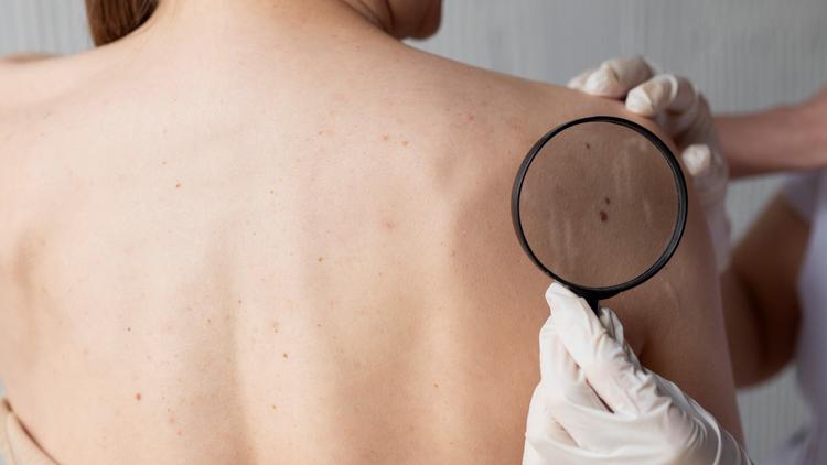 CSBD 2025: Quais as novidades sobre o diagnóstico das lesões melanocíticas?