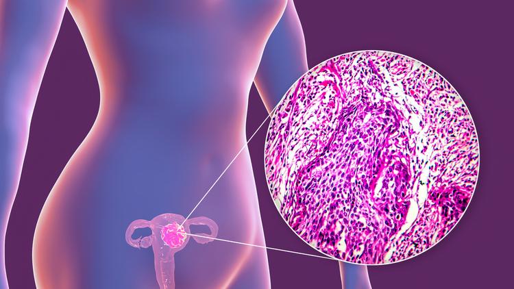 carcinoma