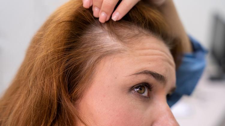 Bicalutamida no tratamento da alopecia androgenética feminina