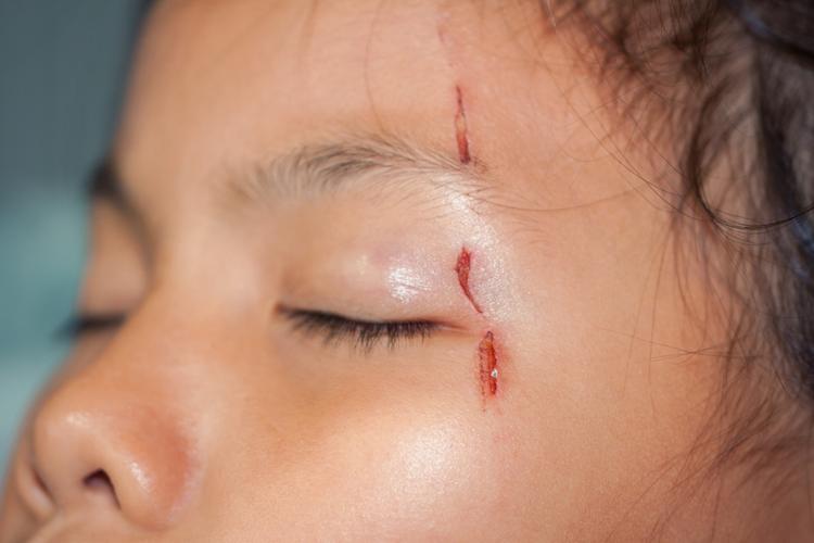 feridas aberta criança
