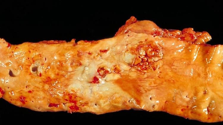 Metas de LDL: estamos longe?