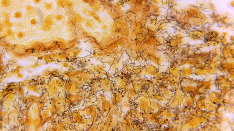 Sífilis no Brasil: queda entre recém-nascidos e aumento entre adultos mais velhos