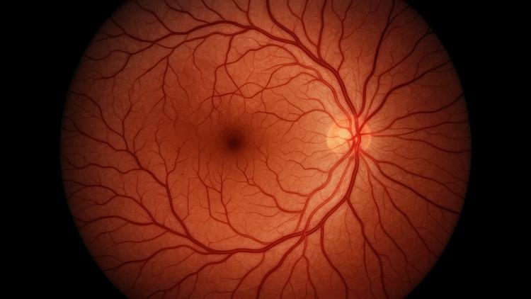 oclusão da artéria da retina