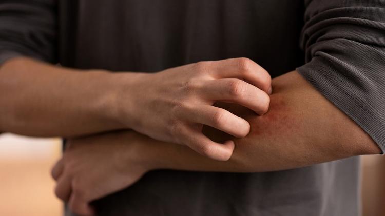 Inibidores de JAK no tratamento da dermatite atópica: eficácia e segurança