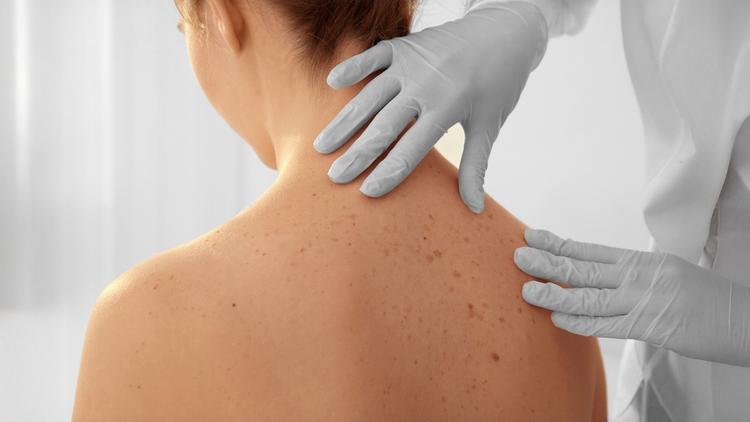 Dezembro Laranja: Carcinomas basocelular e espinocelular