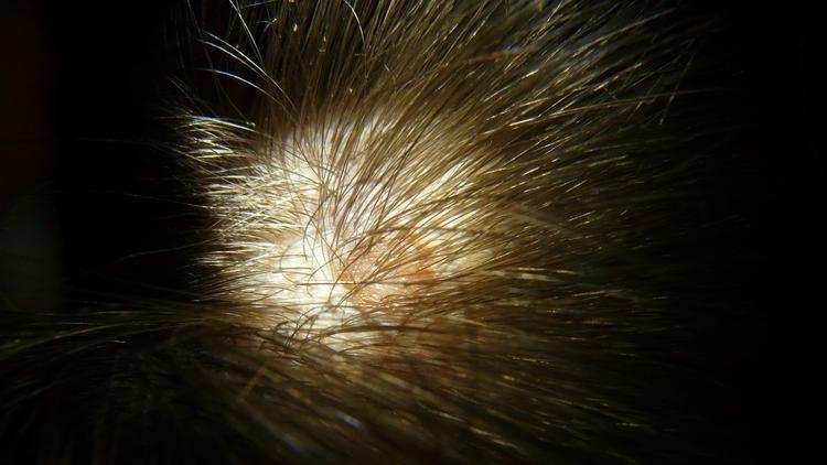 Caso clínico: Escamas grossas no couro cabeludo, qual o diagnóstico?