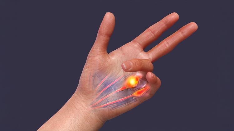 Liberação percutânea ou infiltração para tratamento do dedo em gatilho