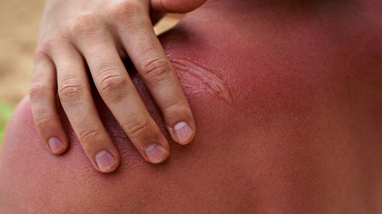 Existe relação entre as queimaduras solares e o carcinoma espinocelular?