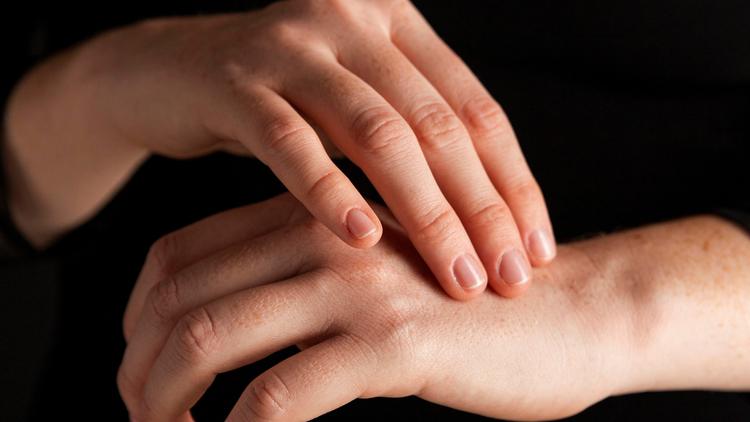 Pustulose palmoplantar: Qual a influência das diferenças étnicas nesta dermatose?