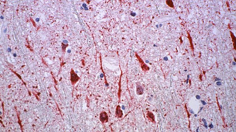 Vírus Nipah: o que o médico deve saber?