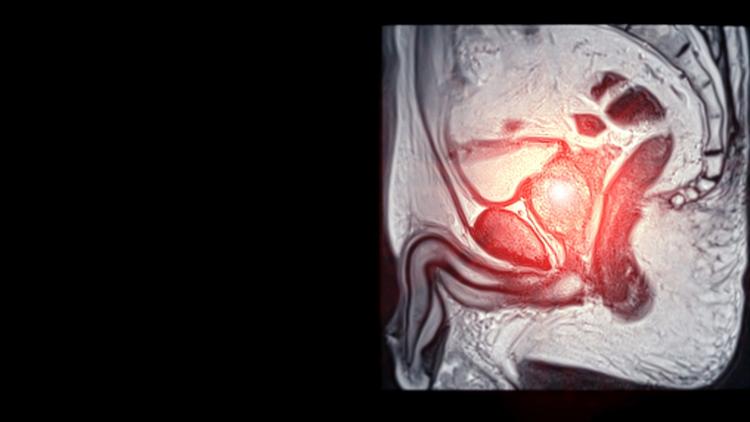 ressonância da próstata