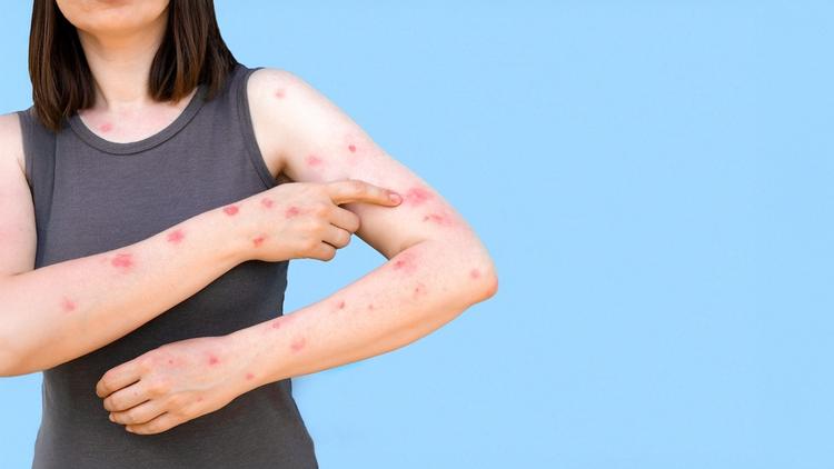 Porto Alegre registra primeiro caso de Mpox em 2026