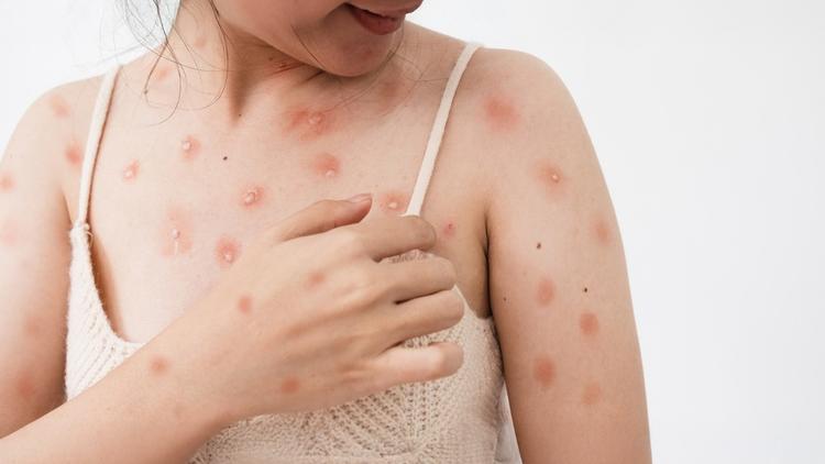 OMS confirma nova variante da Mpox no Reino Unido e na Índia