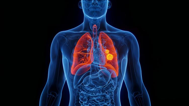 Novo tratamento para câncer de pulmão EGFR mutação atípica em doença avançada
