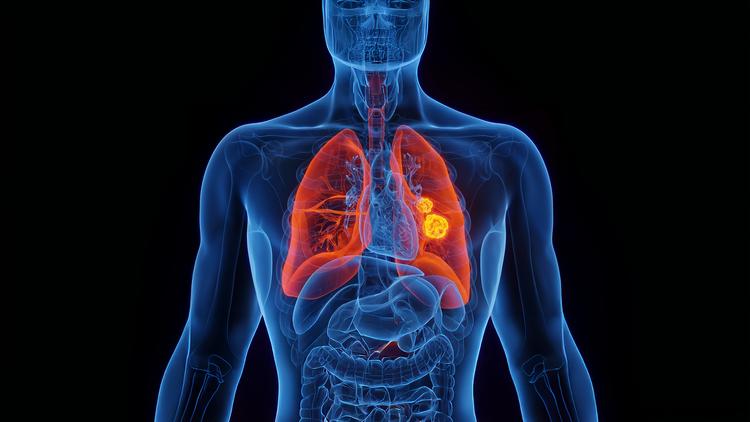 câncer de pulmão sobrevida