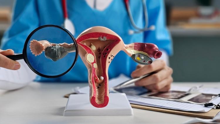 Novo estudo corrobora a importância da classificação molecular no CA de endométrio
