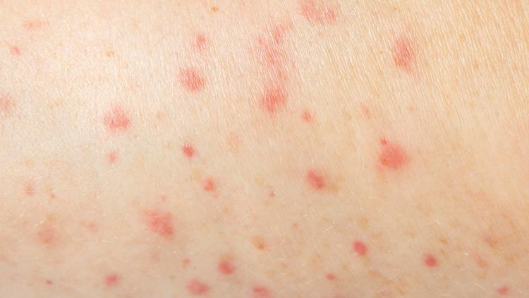 São Paulo registra primeiro caso de sarampo no Brasil em 2026