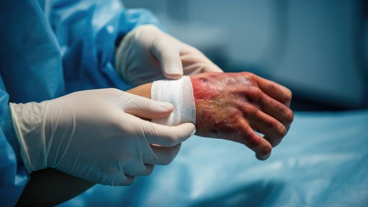 Internação por queimaduras: incidência, complicações e perfil dos pacientes