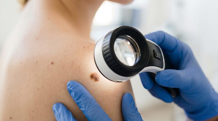 imunoterapia e risco de melanoma
