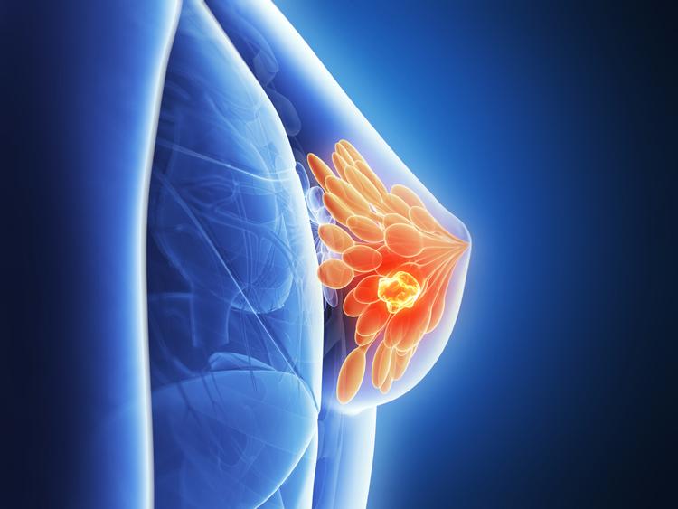 Atualizações da ESMO 2026 em câncer de mama metastático