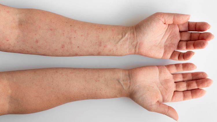 Lúpus eritematoso sistêmico: estudo TULIP-SC avalia anifrolumabe subcutâneo