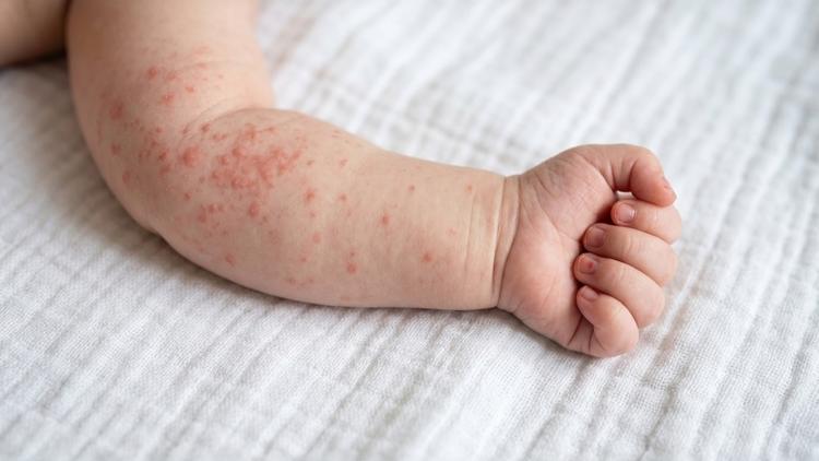 fórmula hidrolisada e prevenção de alergia infantil