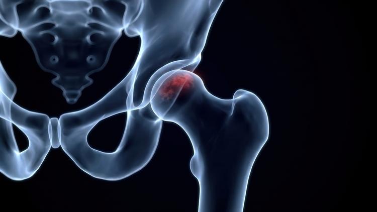fraturas da cabeça femoral