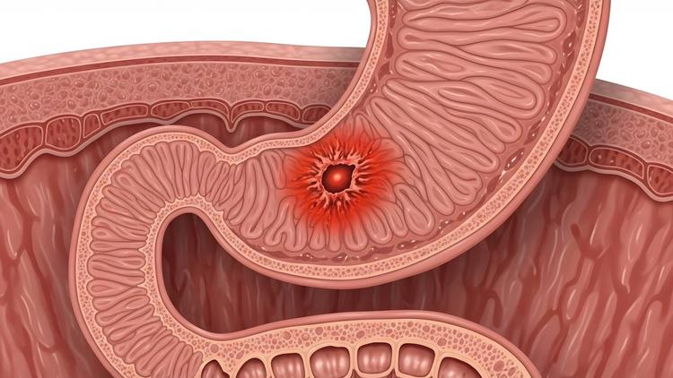 Gastrostomia e fundoplicatura em pediatria