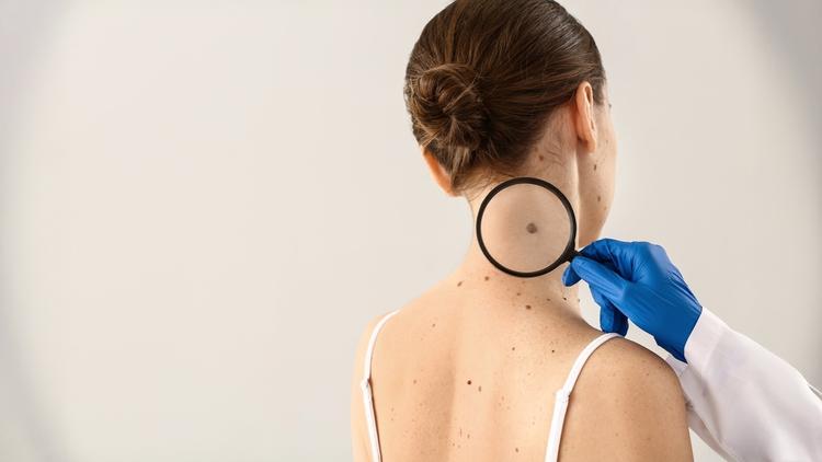 ctDNA na vigilância do melanoma