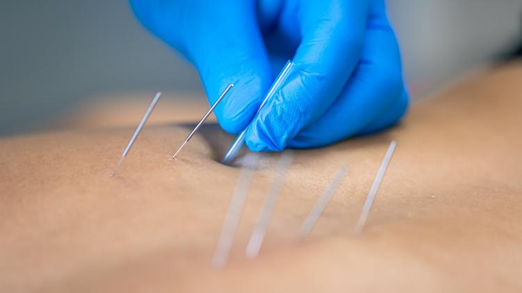 Acupuntura na síndrome do intestino irritável: interpretando as evidências